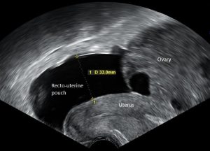 CanTest » Direct access to fast transvaginal ultrasound ...