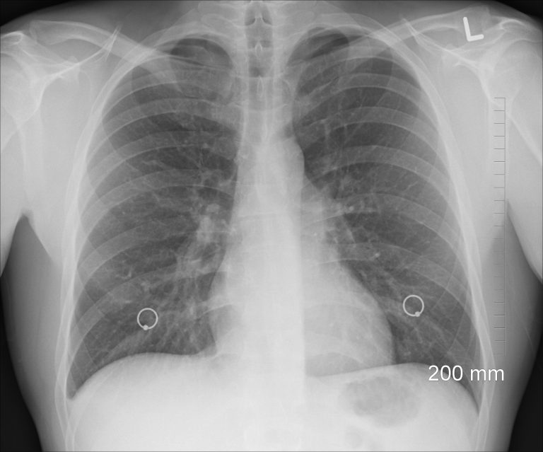 Chest X Ray Lung Cancer Nodule Sexiz Pix